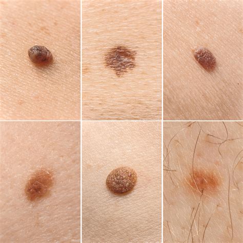 brown moles on penis